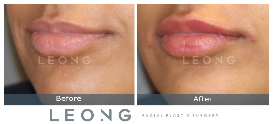 Lip Augmentation Before and After | Leong Facial Plastic Surgery