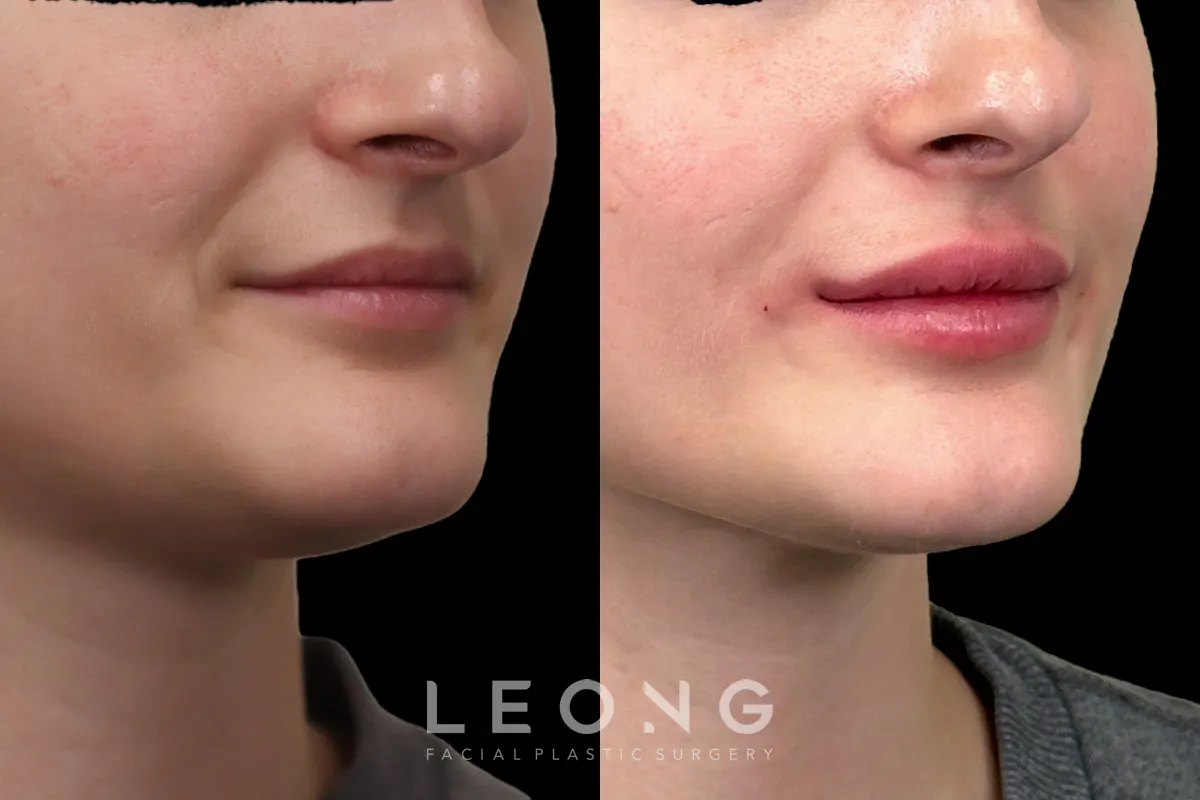 Lip Augmentation Before and After | Leong Facial Plastic Surgery