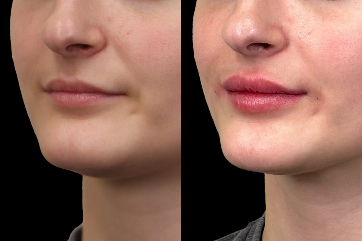 Lip Augmentation Before and After | Leong Facial Plastic Surgery