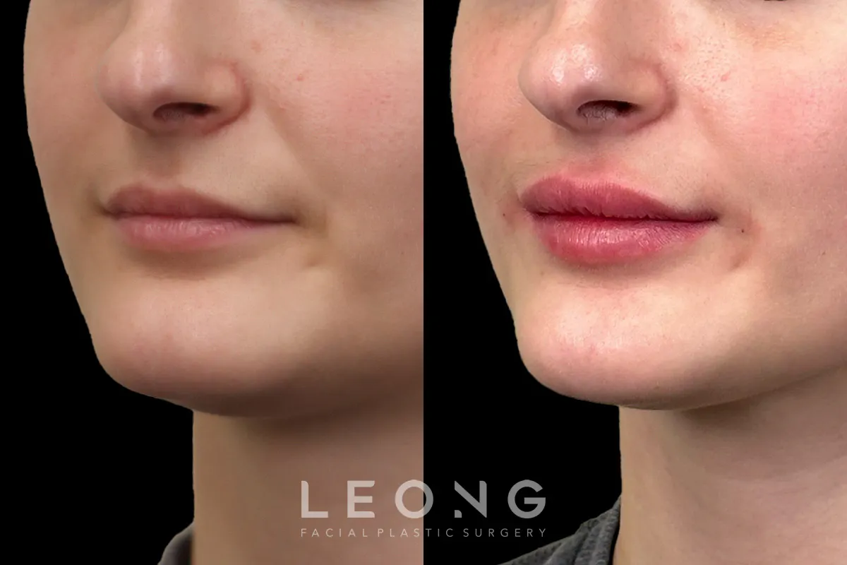 Lip Augmentation Before and After | Leong Facial Plastic Surgery