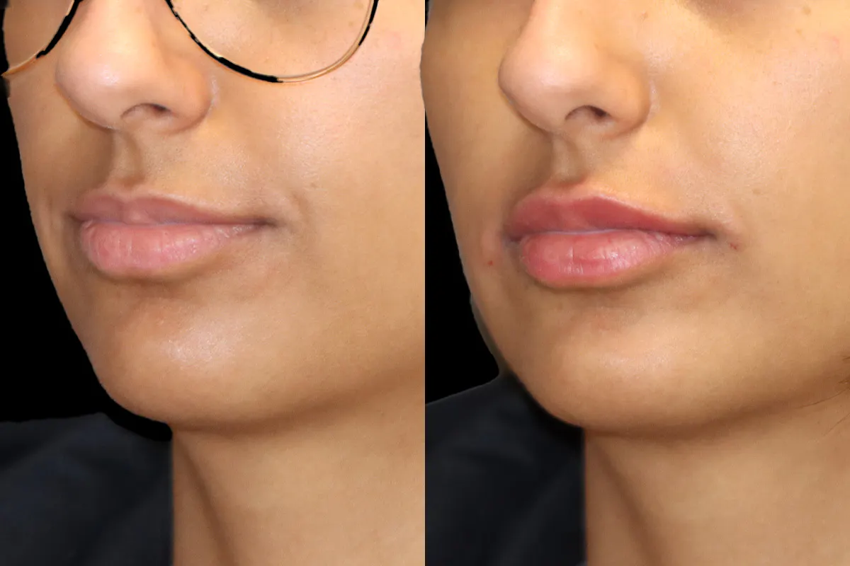 Lip Augmentation Before and After | Leong Facial Plastic Surgery