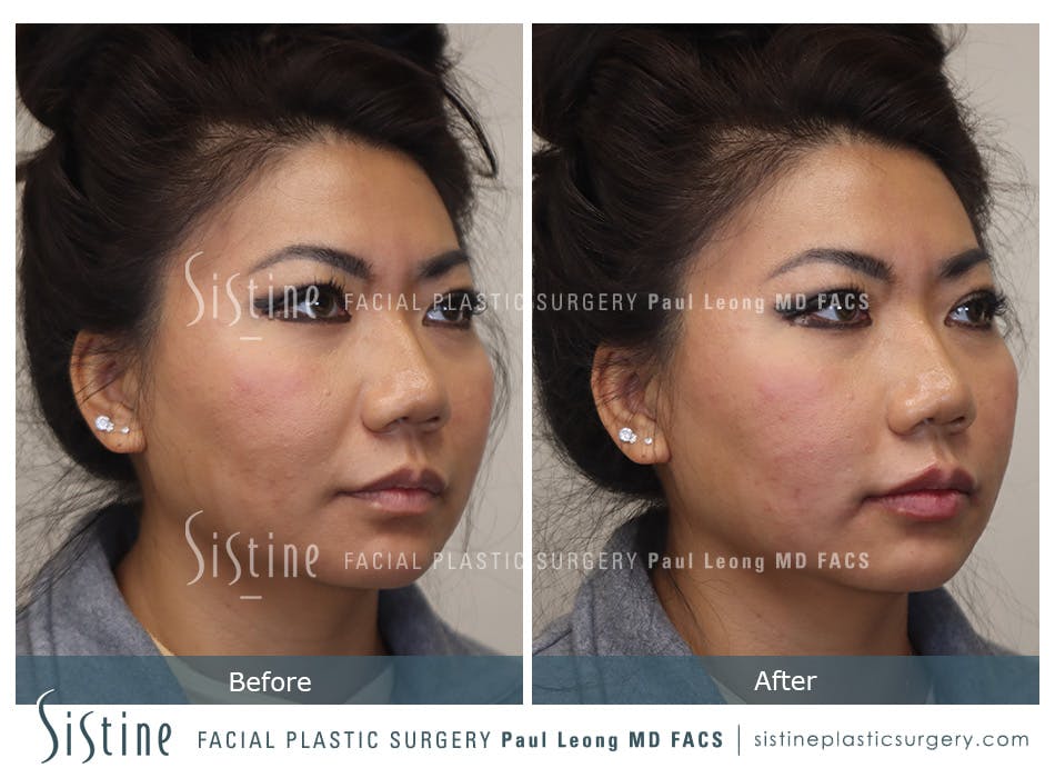 Lip Augmentation Before and After | Leong Facial Plastic Surgery