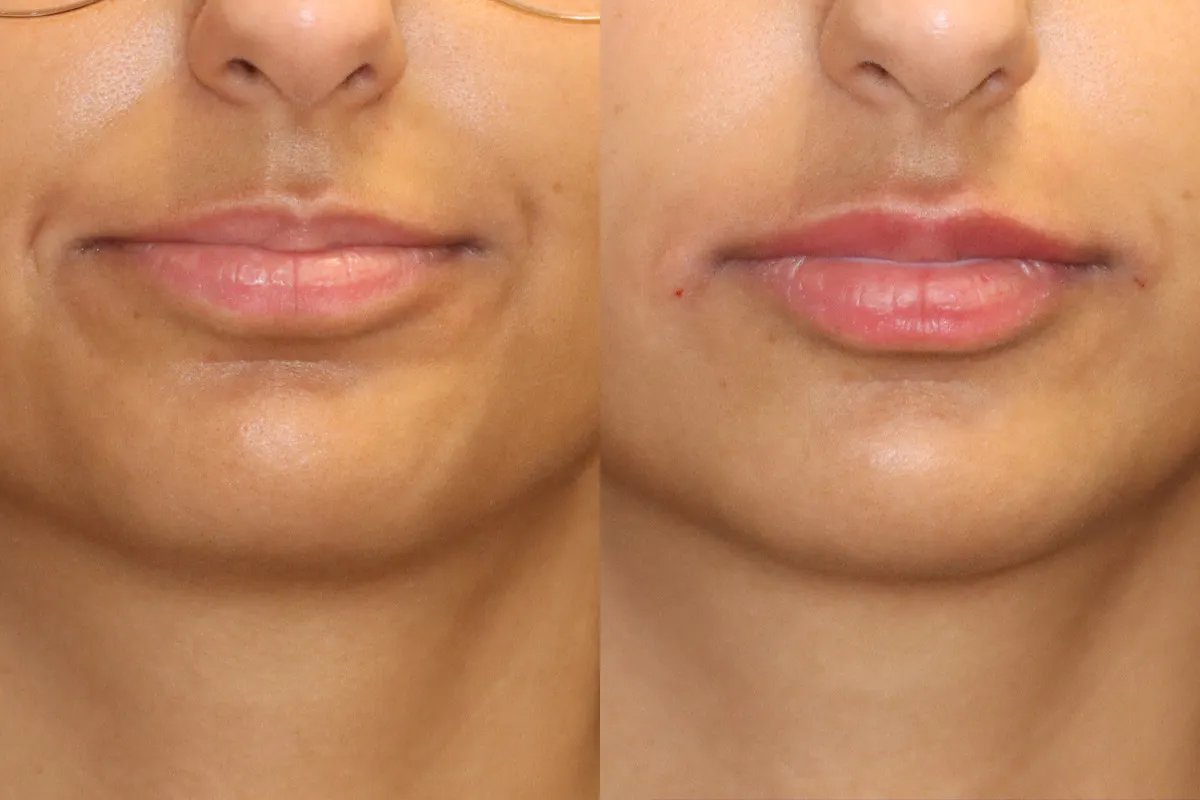 Lip Augmentation Before and After | Leong Facial Plastic Surgery