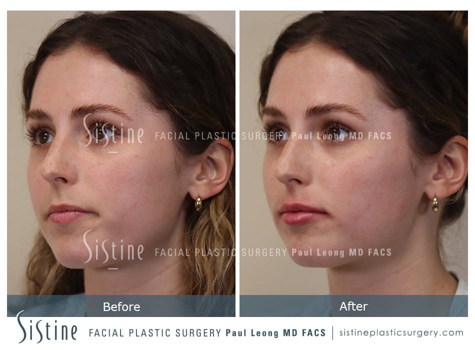 Lip Augmentation Before and After | Leong Facial Plastic Surgery