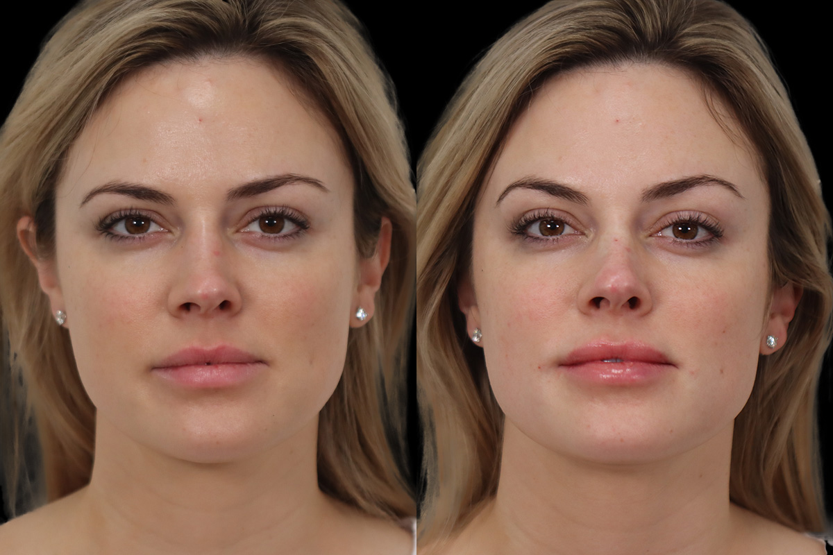 Non Surgical Rhinoplasty Before and After | Leong Facial Plastic Surgery