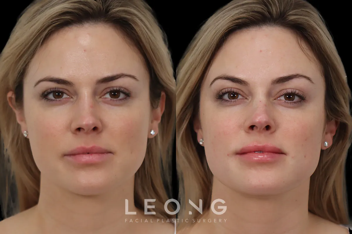 Non Surgical Rhinoplasty Before and After | Leong Facial Plastic Surgery