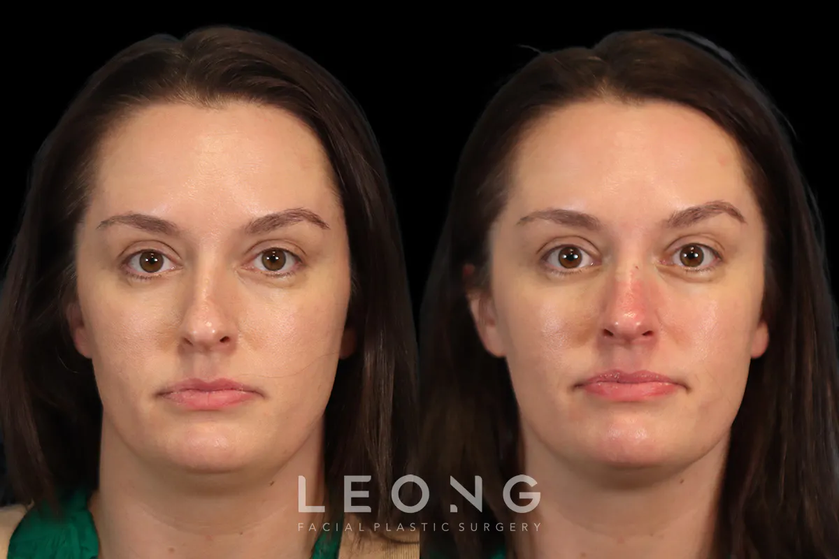 Non Surgical Rhinoplasty Before and After | Leong Facial Plastic Surgery