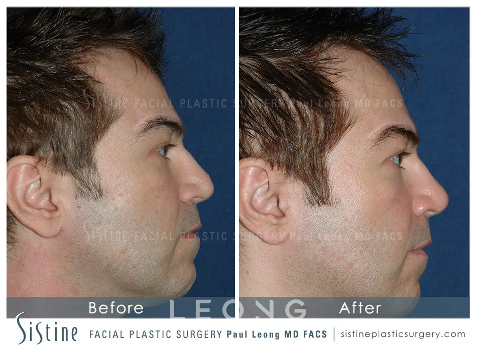 Non Surgical Rhinoplasty Before and After | Leong Facial Plastic Surgery
