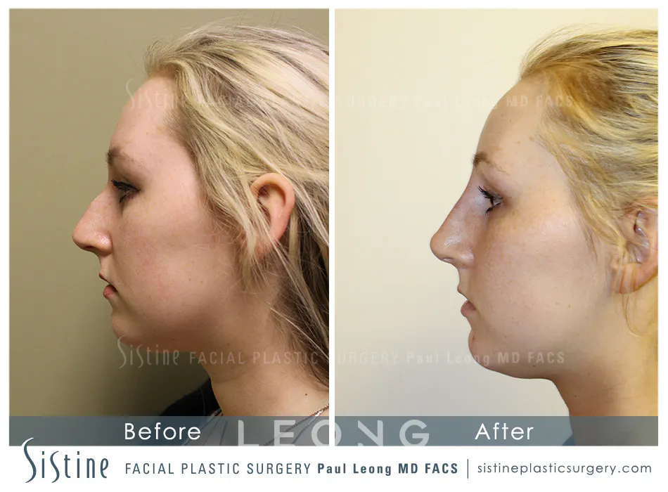 Non Surgical Rhinoplasty Before and After | Leong Facial Plastic Surgery