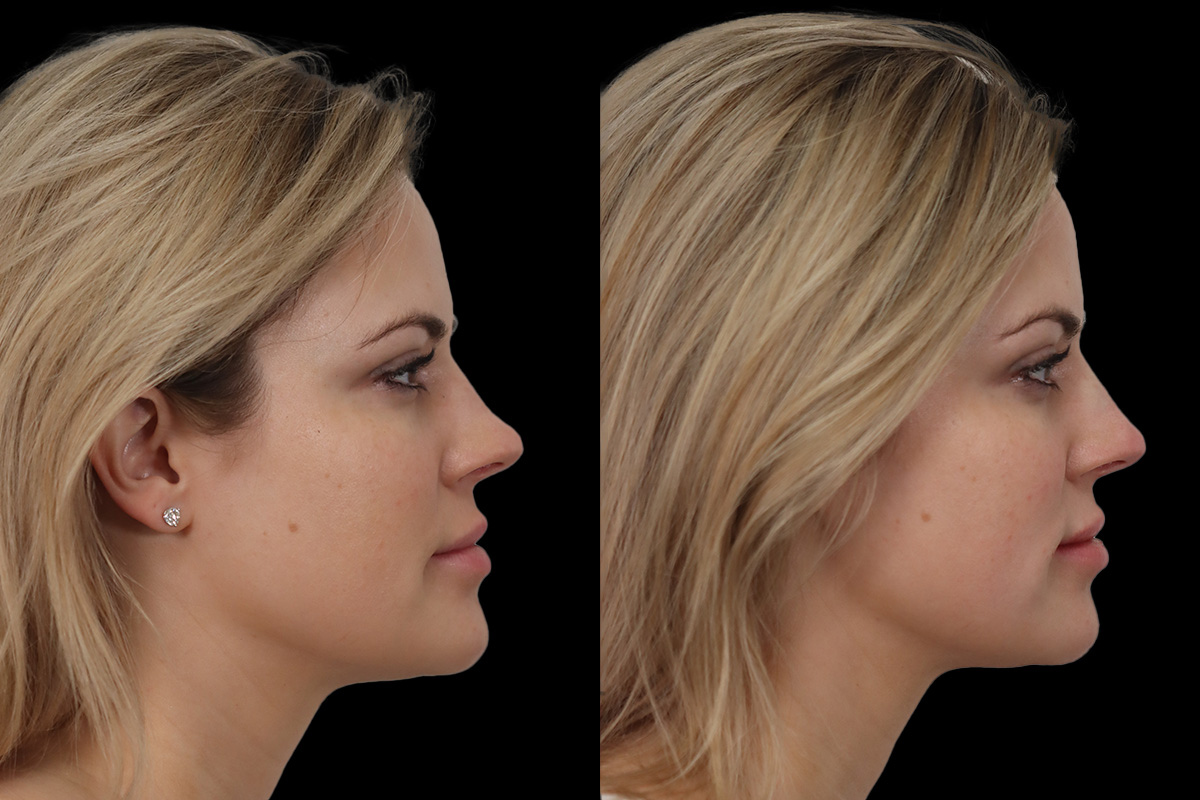 Non Surgical Rhinoplasty Before and After | Leong Facial Plastic Surgery