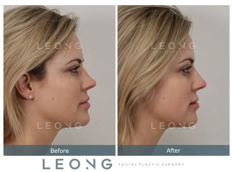 Non Surgical Rhinoplasty Before and After | Leong Facial Plastic Surgery