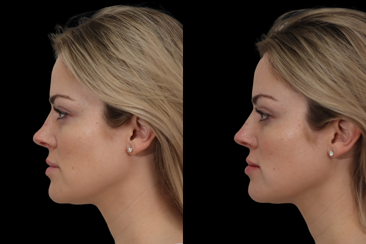 Non Surgical Rhinoplasty Before and After | Leong Facial Plastic Surgery