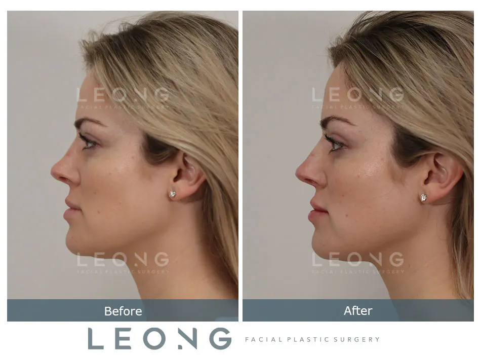Non Surgical Rhinoplasty Before and After | Leong Facial Plastic Surgery