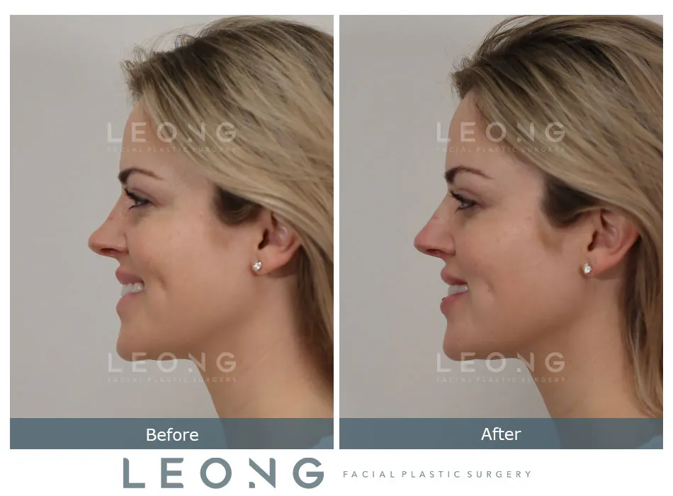 Female Rhinoplasty - Patient Preoperative View | Dr. Paul Leong