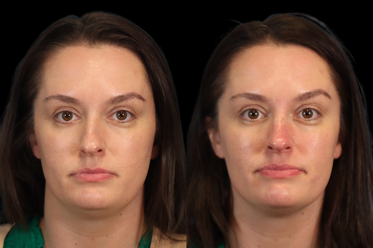 Non Surgical Rhinoplasty Before and After | Leong Facial Plastic Surgery