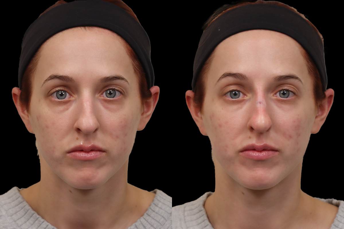Non Surgical Rhinoplasty Before and After | Leong Facial Plastic Surgery