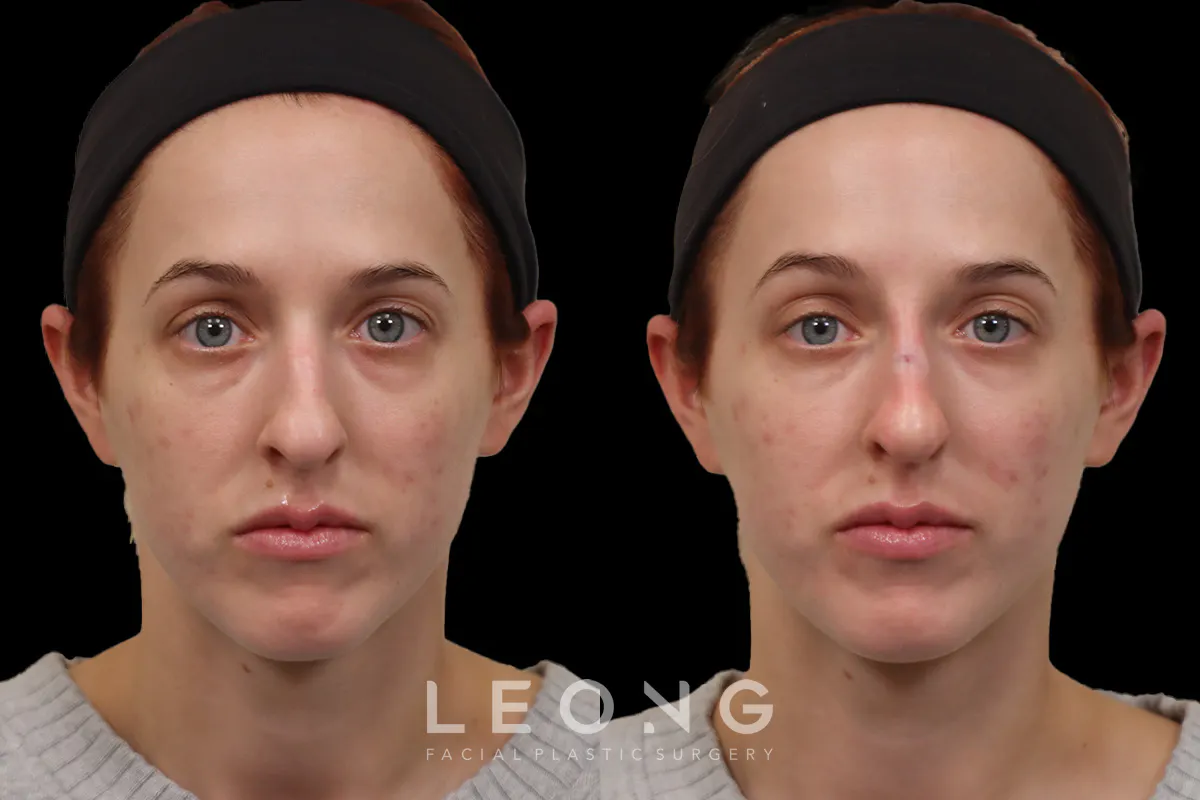 Non Surgical Rhinoplasty Before and After | Leong Facial Plastic Surgery
