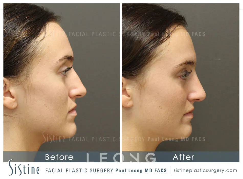 Non Surgical Rhinoplasty Before and After | Leong Facial Plastic Surgery