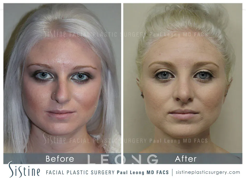 Non Surgical Rhinoplasty Before and After | Leong Facial Plastic Surgery