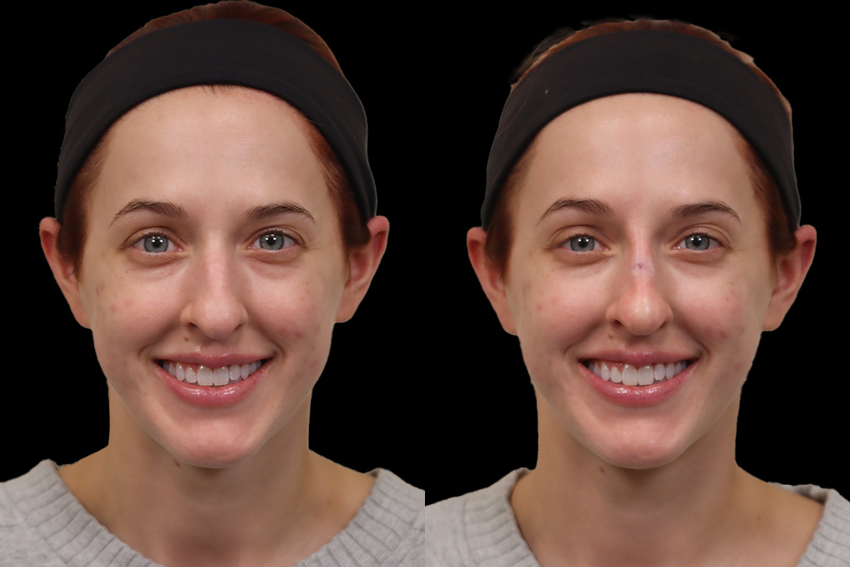 Non Surgical Rhinoplasty Before and After | Leong Facial Plastic Surgery