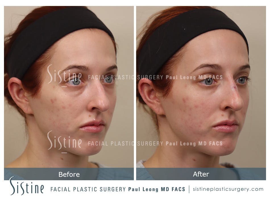 Non Surgical Rhinoplasty Before and After | Leong Facial Plastic Surgery