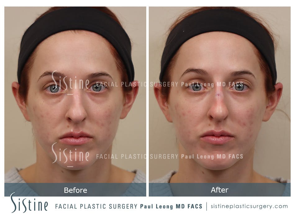 Non Surgical Rhinoplasty Before and After | Leong Facial Plastic Surgery