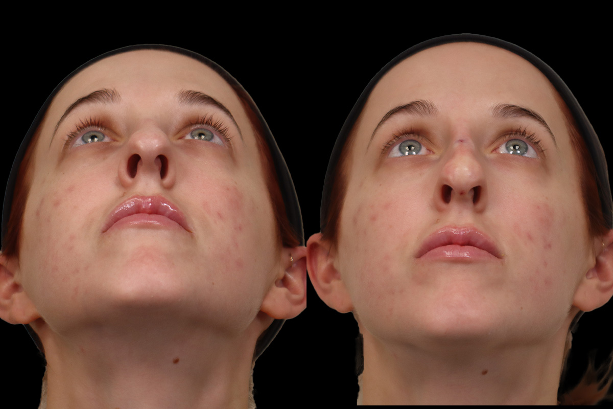Non Surgical Rhinoplasty Before and After | Leong Facial Plastic Surgery