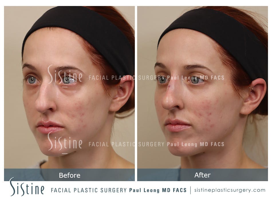Non Surgical Rhinoplasty Before and After | Leong Facial Plastic Surgery