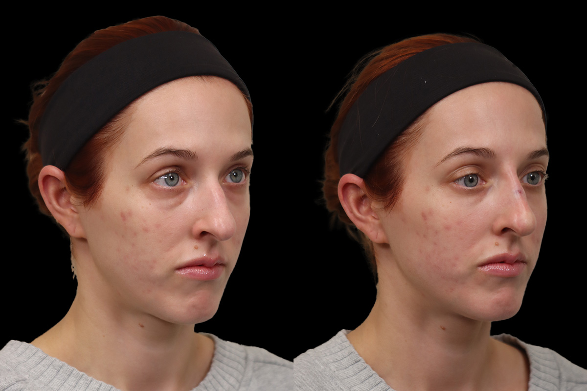 Non Surgical Rhinoplasty Before and After | Leong Facial Plastic Surgery