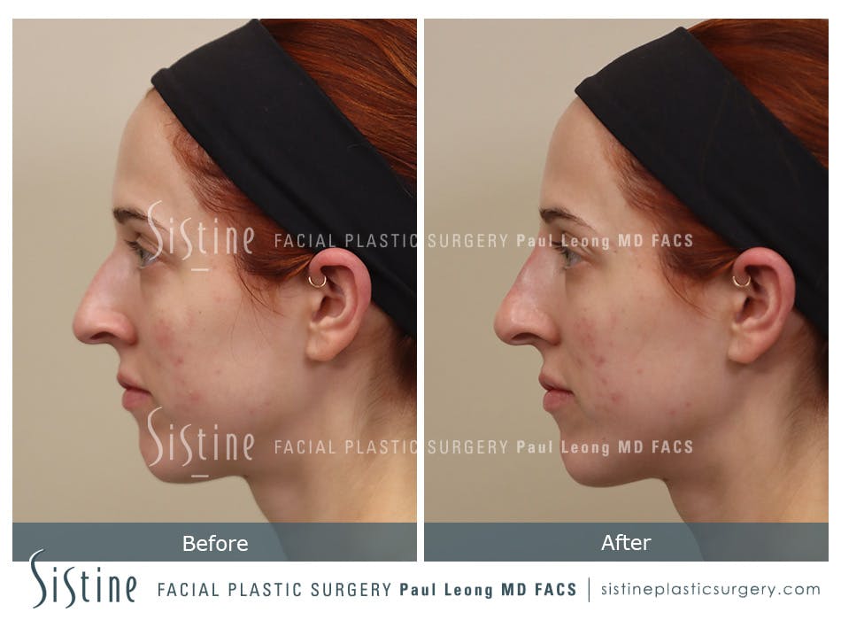 Non Surgical Rhinoplasty Before and After | Leong Facial Plastic Surgery