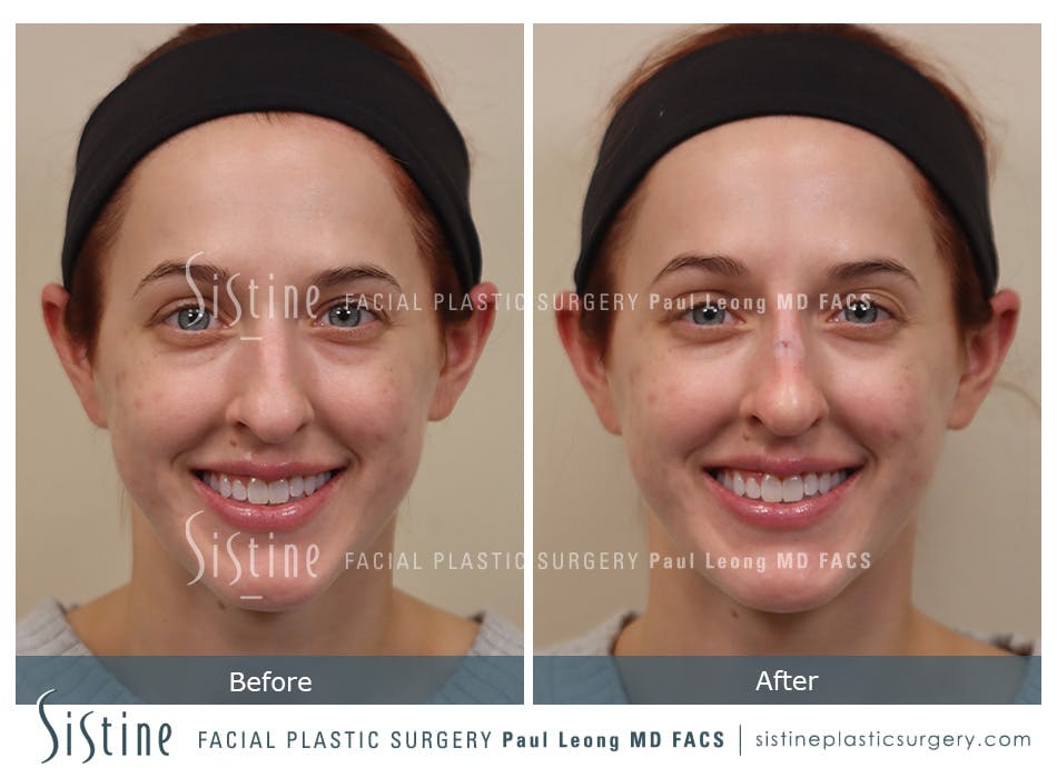 Non Surgical Rhinoplasty Before and After | Leong Facial Plastic Surgery
