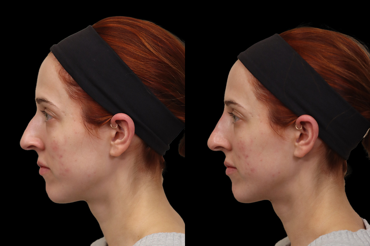 Non Surgical Rhinoplasty Before and After | Leong Facial Plastic Surgery