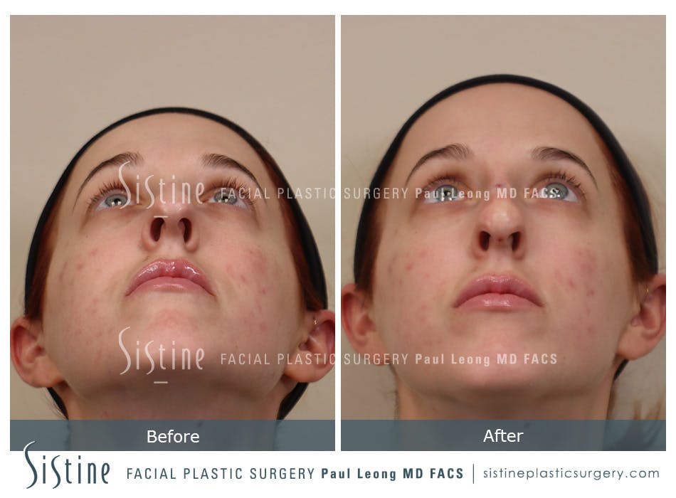 Non Surgical Rhinoplasty Before and After | Leong Facial Plastic Surgery