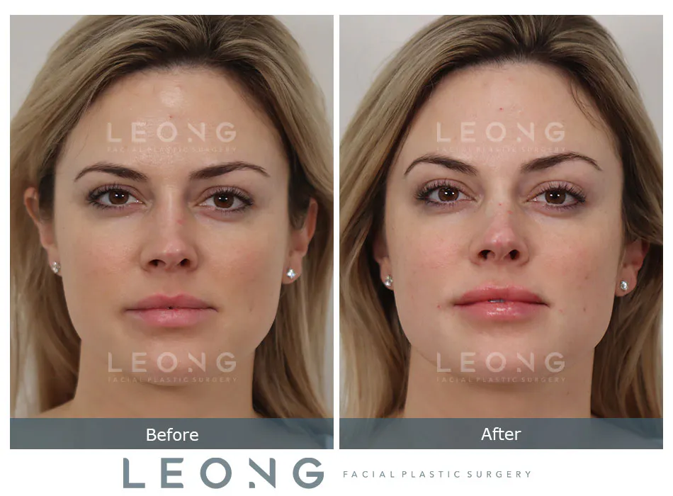 Non Surgical Rhinoplasty Before and After | Leong Facial Plastic Surgery