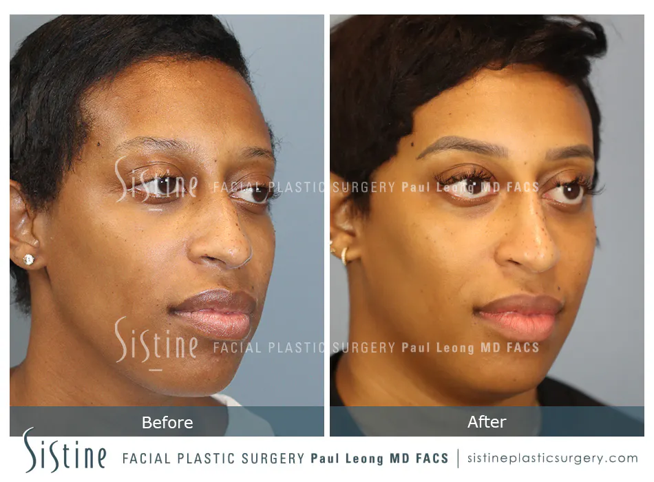 Non Surgical Rhinoplasty Before and After | Leong Facial Plastic Surgery