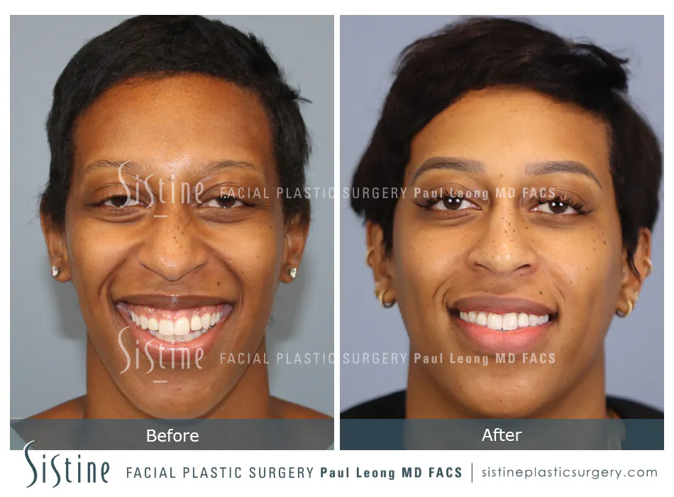 Non Surgical Rhinoplasty Before and After | Leong Facial Plastic Surgery