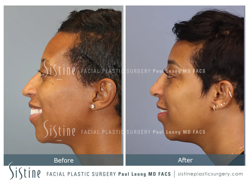 Non Surgical Rhinoplasty Before and After | Leong Facial Plastic Surgery