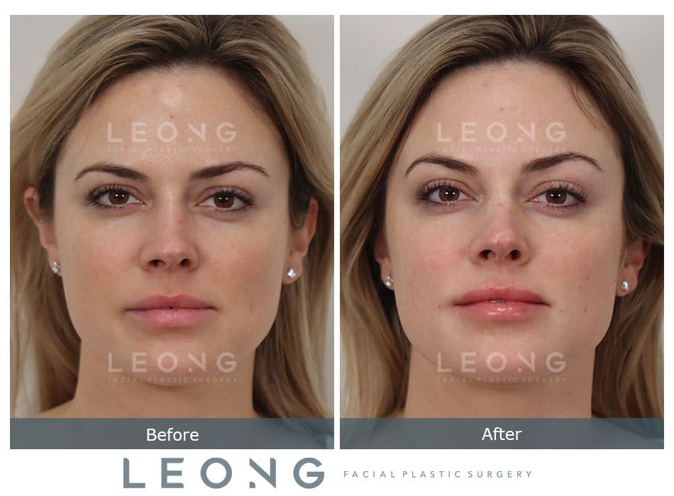 Non Surgical Rhinoplasty Before and After | Leong Facial Plastic Surgery