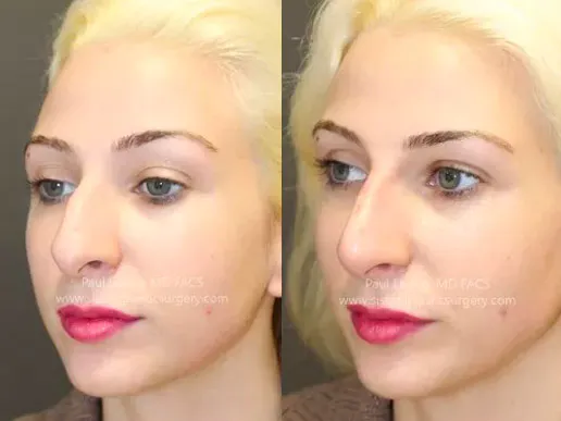 Non Surgical Rhinoplasty Before and After | Leong Facial Plastic Surgery