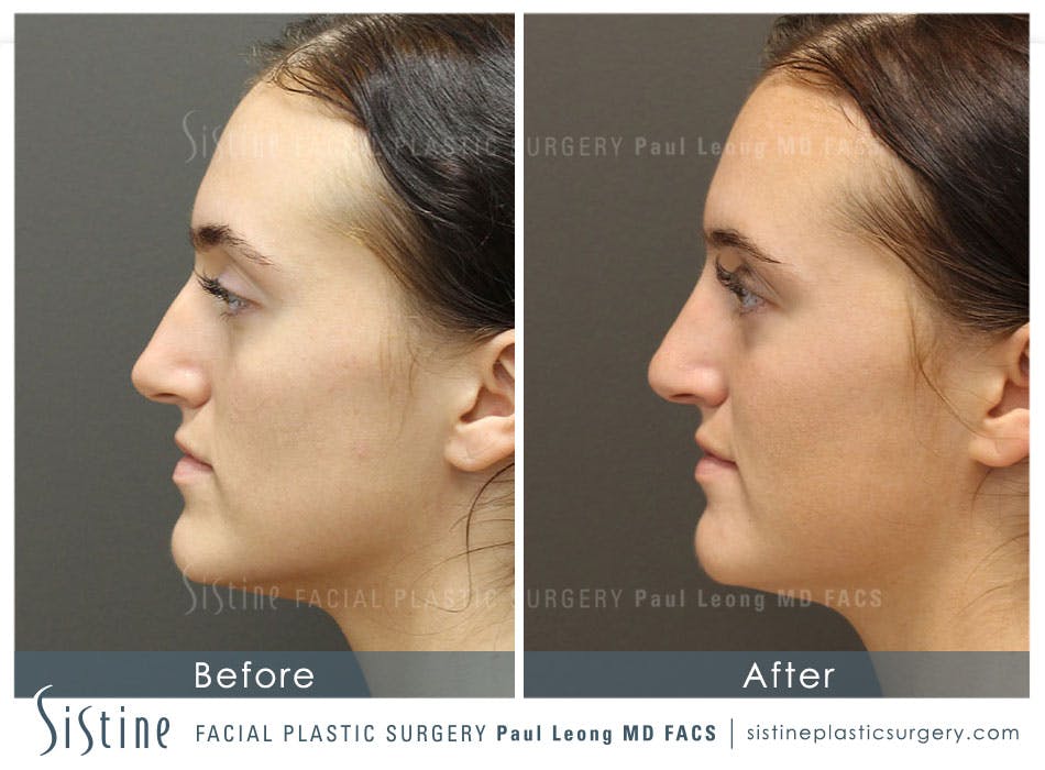 Non Surgical Rhinoplasty Before and After | Leong Facial Plastic Surgery
