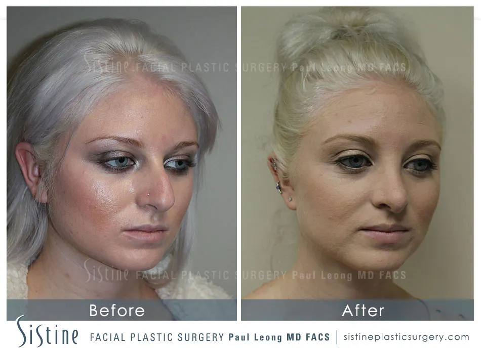 Non Surgical Rhinoplasty Before and After | Leong Facial Plastic Surgery