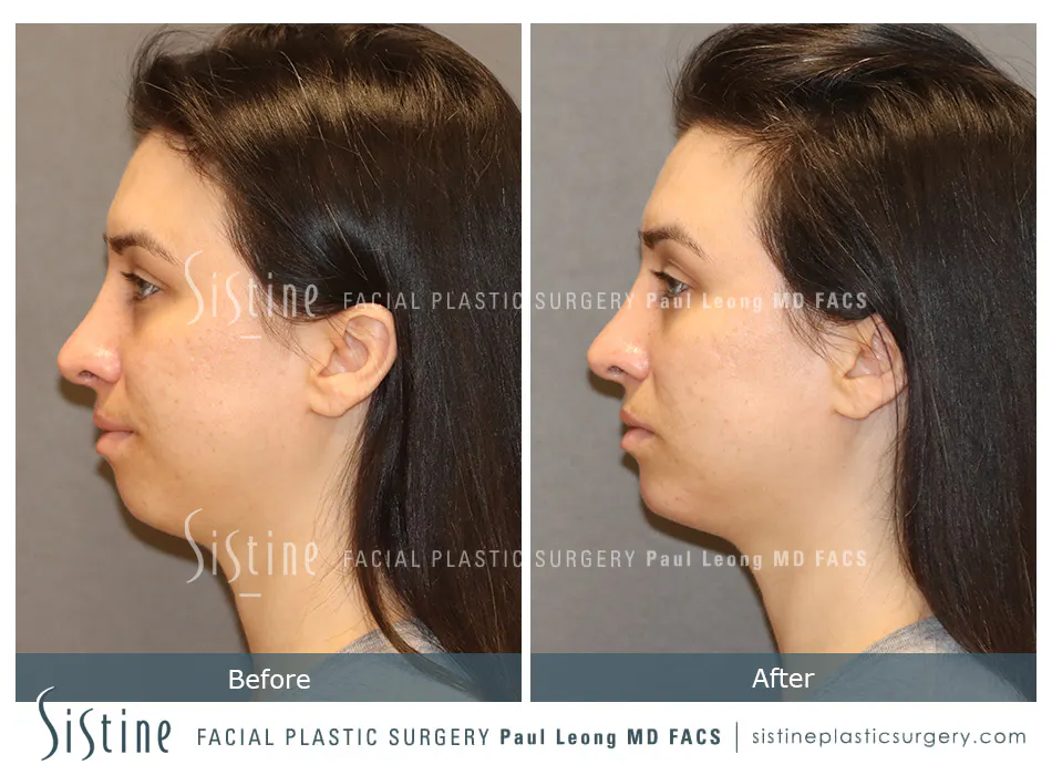 Restylane Juvederm Before and After | Leong Facial Plastic Surgery