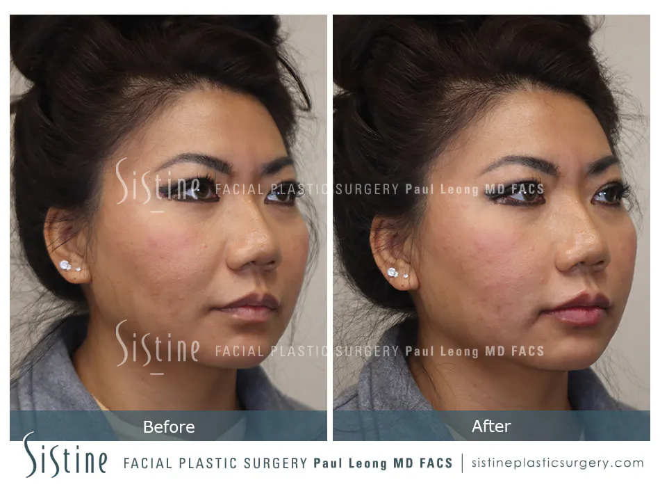 Restylane Juvederm Before and After | Leong Facial Plastic Surgery