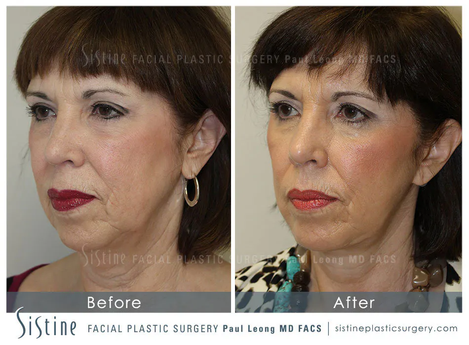 Restylane Juvederm Before and After | Leong Facial Plastic Surgery