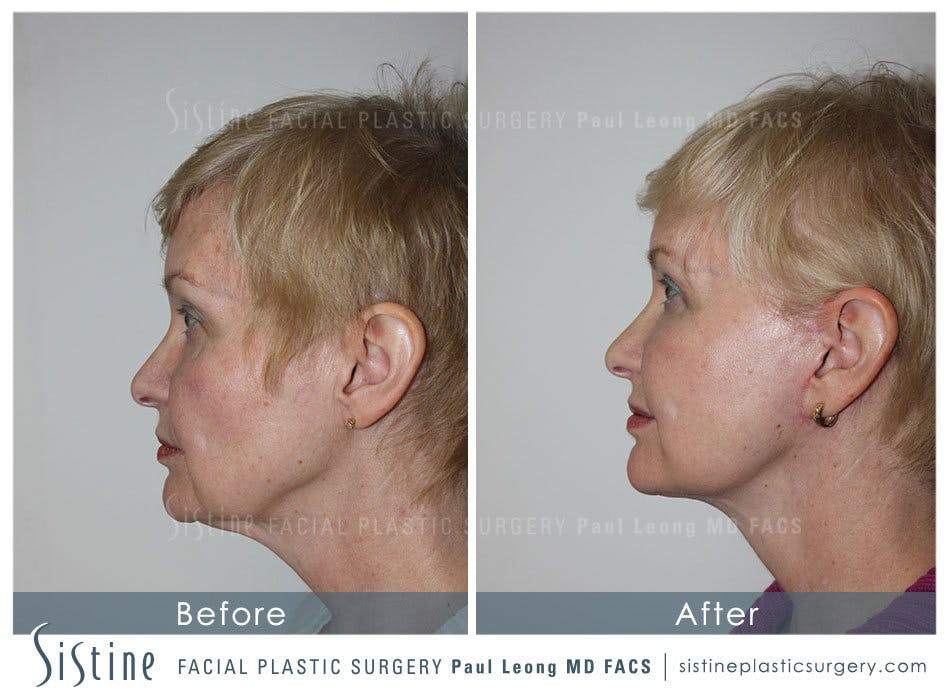 Restylane Juvederm Before and After | Leong Facial Plastic Surgery
