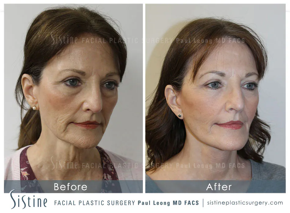 Restylane Juvederm Before and After | Leong Facial Plastic Surgery