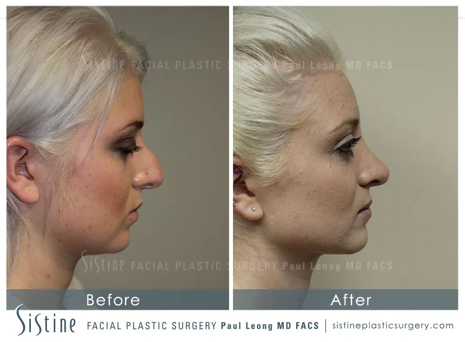 Restylane Juvederm Before and After | Leong Facial Plastic Surgery