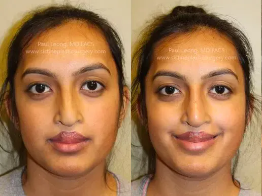 Restylane Juvederm Before and After | Leong Facial Plastic Surgery