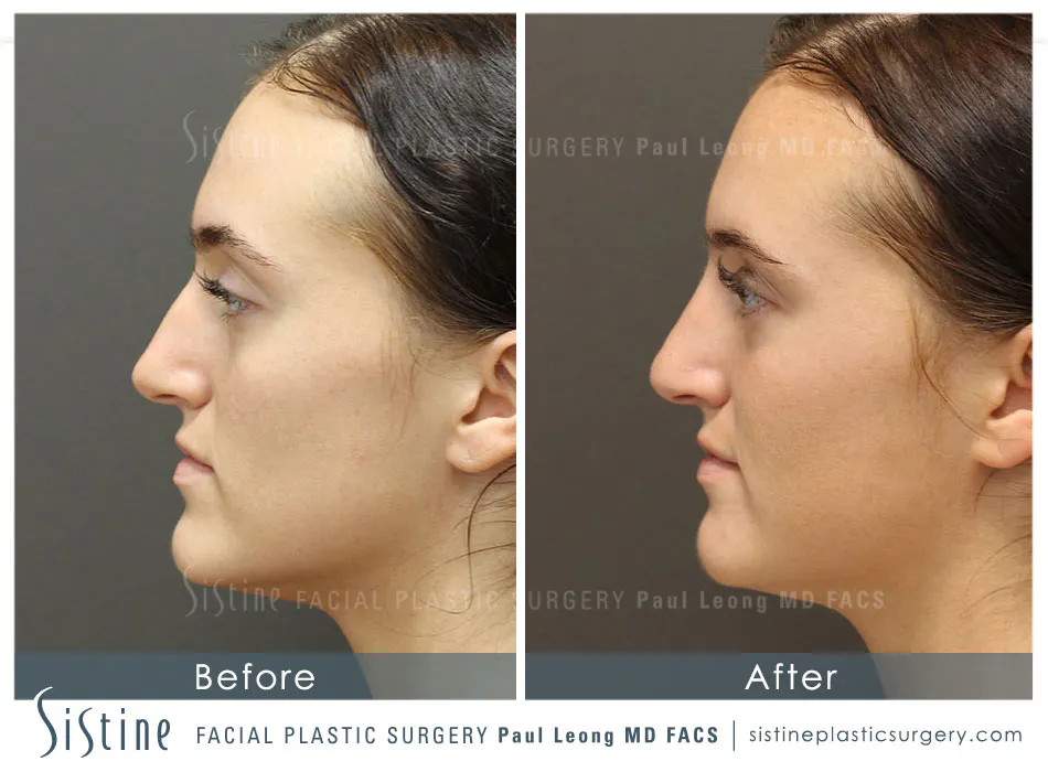 Restylane Juvederm Before and After | Leong Facial Plastic Surgery