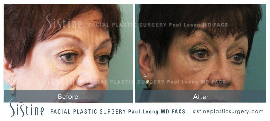 Restylane Juvederm Before and After | Leong Facial Plastic Surgery